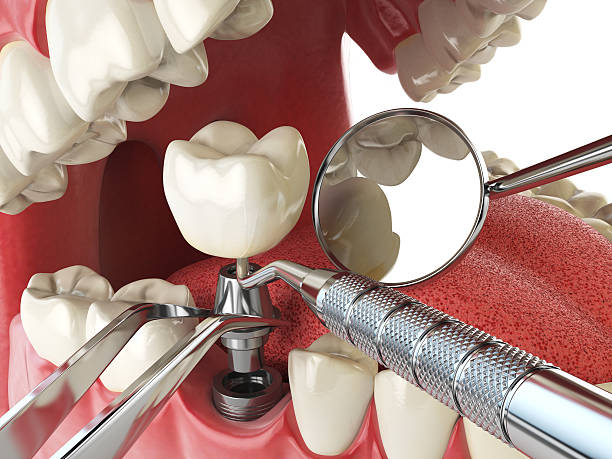 Best Emergency Tooth Extraction in Mascot, TN